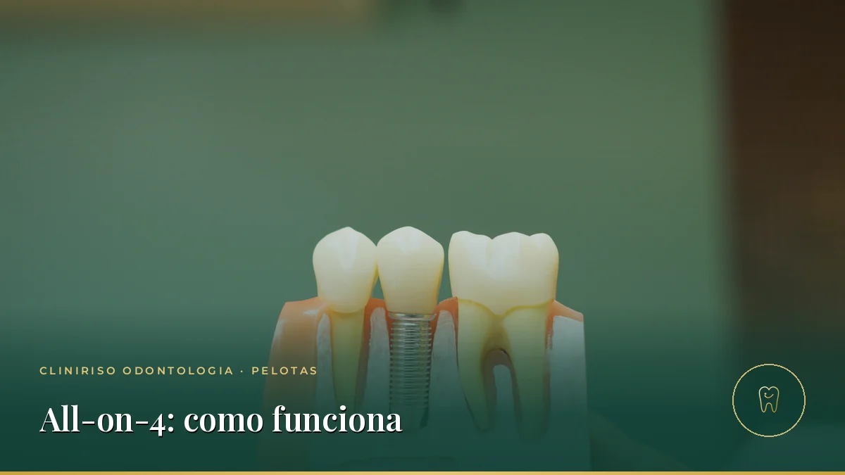 All-on-4: como funciona ter dentes fixos em poucos dias? — Cliniriso, Pelotas